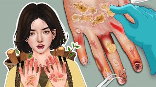 ASMR Best Treatment for Dermatitis of the Hands for Major Acne Hands Dead Skin Swelling [upl. by Haduj907]