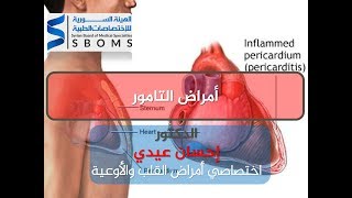 أمراض التامور  pericardial diseases [upl. by Ennyletak412]