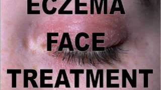 How To Treat Exzema Face  Exzema Face Remedies [upl. by Schapira]