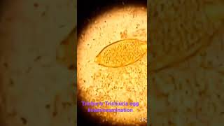 Trichuris Trichuria egg in stool examination filariasis pathology microbiology shorts parasite [upl. by Assetal470]