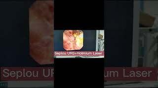 Holmium laser and Seplou URS in lithotripsy kidney stone [upl. by Drucy204]