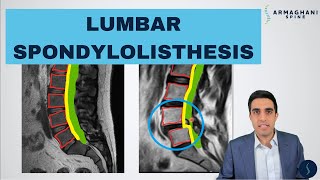 Lumbar Spondylolisthesis  Anatomy Symptoms Causes Treatments and more [upl. by Naicul]