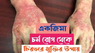 এক্সিমা থেকে চিরতরে মুক্তি  Atopic darmatitis  Skin Care  Skin Problem [upl. by Sheppard]