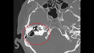 HRCT Temporal bone  A more detailed version  Basic to Advanced  AXIAL amp CORONAL VERSION 2 [upl. by Kennett]