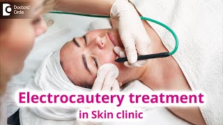 Use of Electrocautery Treatment in Skin Clinic  Electrocautery  Dr Rasya Dixit  Doctors Circle [upl. by Norina]