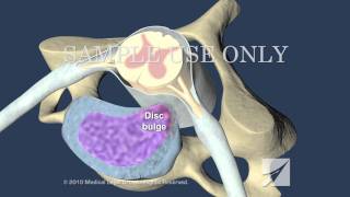 Cervical Disc Herniation [upl. by Suryc737]