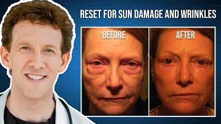 RESET for Sun Damage with Dr Adam Scheiner  Marilyns Testimonial [upl. by Intisar683]