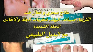 كريم فعال لعلاج فطريات الجلد والأظافر، كزيما، صيبانة، الحكة والبهك ميكوستر Mycoster 1 مع بديل طبيعي [upl. by Gilcrest]