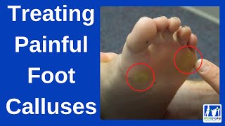 How to Treat Painful Foot Calluses [upl. by Ebehp]