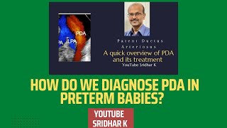 How do we diagnose PDA to guide treatment PDA PDAtreatment [upl. by Macnamara]