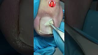 Врос ноготь на ноге Что делать Ingrown nail Как убрать вросший ноготь shortsvideo nails [upl. by Feld286]