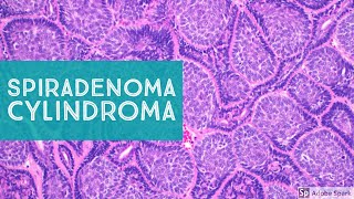 Spiradenoma amp CylindromaSweat Gland Tumor Pathology [upl. by Herve]