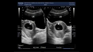 A blighted ovum also called an anembryonic pregnancy [upl. by Oterol]