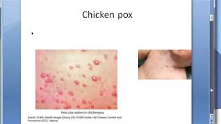 Microbiology 457 a Chicken pox VZV Varicella Zoster HHV3 Virus Difference Shingles [upl. by Kramal]