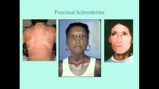 Scleroderma  CRASH Medical Review Series [upl. by Elfreda661]