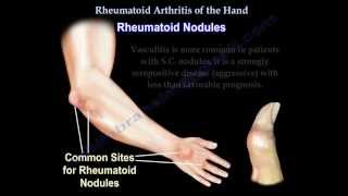 Rheumatoid Arthritis of the hand  Everything You Need To Know  Dr Nabil Ebraheim [upl. by Phyllida86]