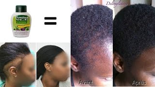 Comment FAIRE POUSSER les CHEVEUX des TEMPES [upl. by Novyaj]