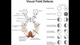 Lesions in the lower optic radiations and superior quadrantanopia [upl. by Oirasan]