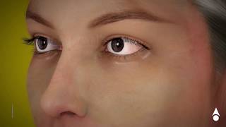 Cataract animation for Patient Education [upl. by Pinebrook]