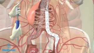 Operatie aneurysma van de buikslagader EVARprocedure [upl. by Ynehteb]