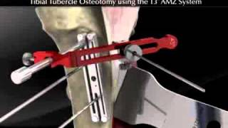 Tibial Tubercle Osteotomy using the T3 AMZ System [upl. by Keriann261]