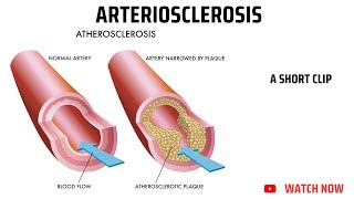 Arteriosclerosis [upl. by Esilahc]