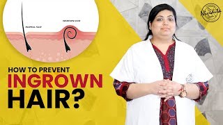 How to remove ingrown hair  How to prevent Ingrown Hair  Ingrown hair on legs [upl. by Aleira]