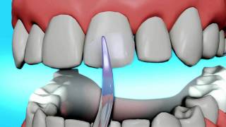 Dental Bonding Video  Tooth Bonding [upl. by Esilahc]