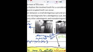 Odontogenic cysts 1 part 1 [upl. by Bibi]