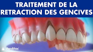 Récession Gingivale – Traitement de la retraction des gencives © [upl. by Arerrac]