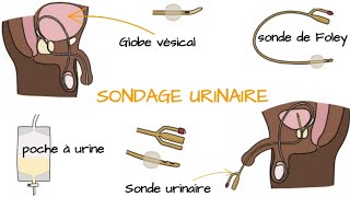 Comprendre le SONDAGE URINAIRE [upl. by Negeam]