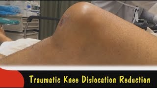 Traumatic Knee Dislocation Reduction [upl. by Minton542]