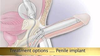 Potency ED Treatment Options [upl. by Satsoc560]