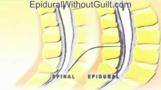 Animation of Difference Between Epidural and Spinal Techniques [upl. by Daffodil452]