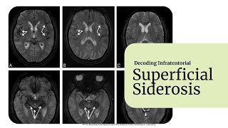 Decoding Superficial Siderosis [upl. by Cofsky656]