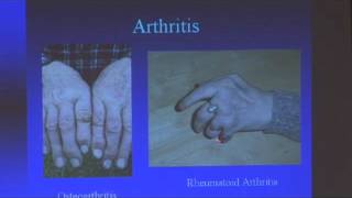 Cubital Tunnel Syndrome [upl. by Lainahtan]