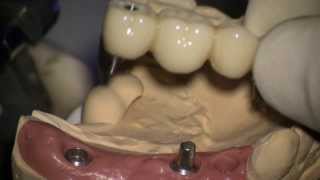 Dental implant Screw and cementretained provisional restoration setting 3 [upl. by Eenimod266]