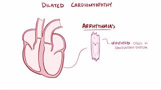 Dilated cardiomyopathy DCM causes symptoms diagnosis treatment amp pathology [upl. by Tham]