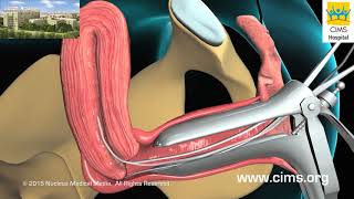 Endometrial Biopsy Hindi  CIMS Hospital [upl. by Terryn]