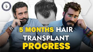 RJ Veers Hair Transplant 2024  Cost of Hair Transplant amp Hair Transplant Doctor in Surat [upl. by Mayne]