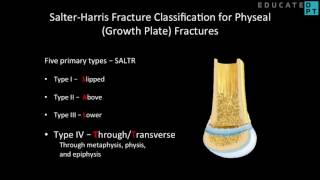 Salter Harris Fracture Classification for Growth Plate Fractures [upl. by Wawro]