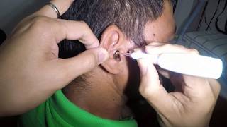 Mans Earwax Removed for the First Time [upl. by Stepha]