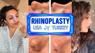 BULBOUS THICK SKIN RHINOPLASTY VLOG TURKEY  DR RESIT BURAK KAYAN  NOSE JOB TURKEY  Hadia [upl. by Ibbie535]