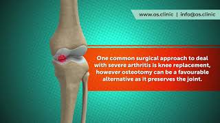 What is an knee osteotomy [upl. by Etteuqram]