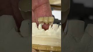 Zirconia Pontic Bridge with great cleansibility dental teeth smile lsk121shorts shortvideo [upl. by Haduj144]