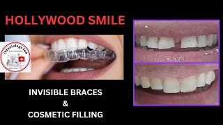 CLEAR ALIGNER amp COSMETIC FILLING FOR HOLLYWOOD SMILE  ORTHODONTICS amp RESTORATIVE SMILE DESIGNING [upl. by Atnwahs836]