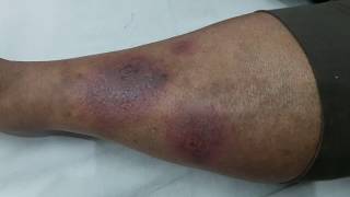 Erythema Nodosum in SLE [upl. by Backer]