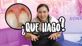 👉 Desgaste en el cuello dental  Las Causas y tratamiento para Abfracción dental [upl. by Michaelina]