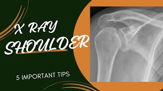 X RAY SHOULDER JOINT  PRACTICAL APPROACH  REFLECTION 6 [upl. by Ettennahs]