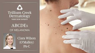 Learn the ABCDEs of Melanoma [upl. by Nnylyram]